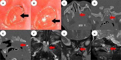 A Rare Case of a Congenital Nasopharyngeal Ganglioglioma With Dyspnea in a 1-Month-Old Male Infant: A Case Report